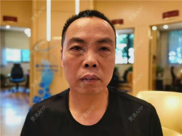 更美 - 更美用户IG0lQLfUjW的外切去眼袋经验 | 杭州 | 外切去眼袋