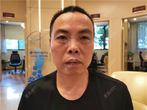 更美 - 更美用户IG0lQLfUjW的外切去眼袋经验 | 杭州 | 外切去眼袋