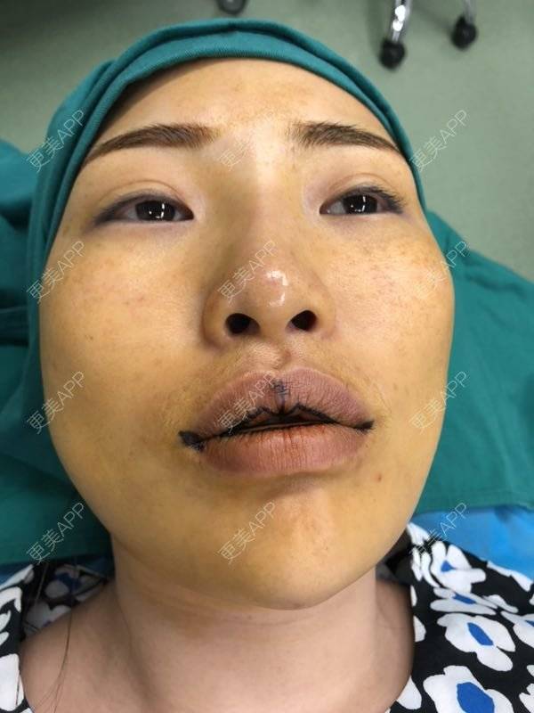 更美用户c4yytxlu7n的m唇成形术日记