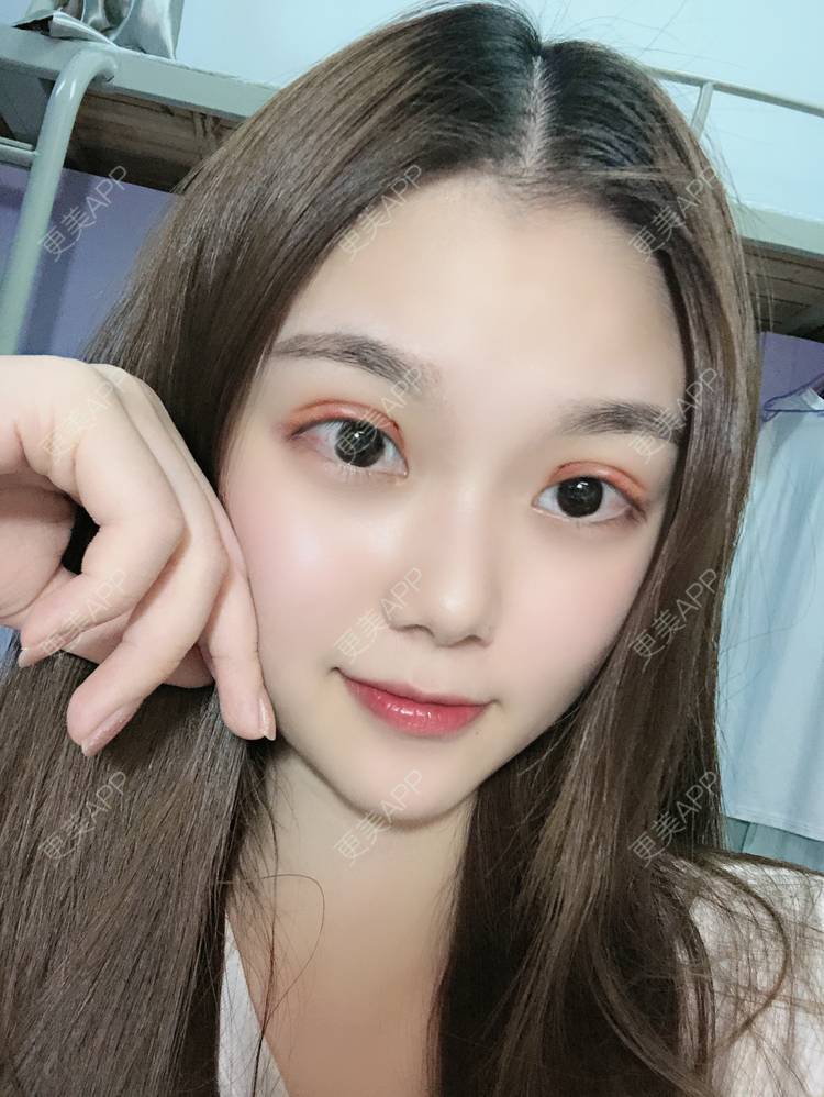 更美用户x6cvq1M3DF的切开双眼皮日记