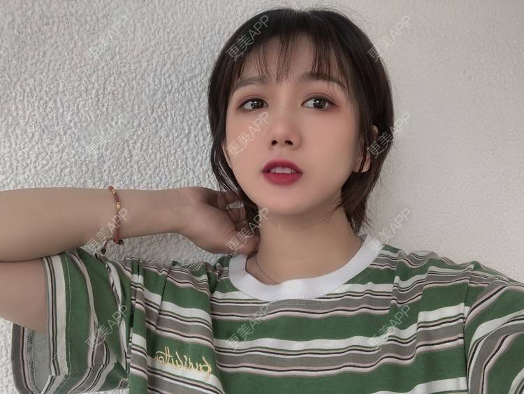 更美 - 阳海斌 医生的埋线提升经验 | 埋线提升 | 视频日记 | 佛山