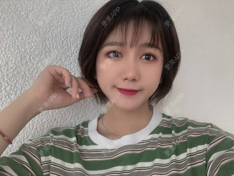 更美 - 阳海斌 医生的埋线提升经验 | 埋线提升 | 视频日记 | 佛山