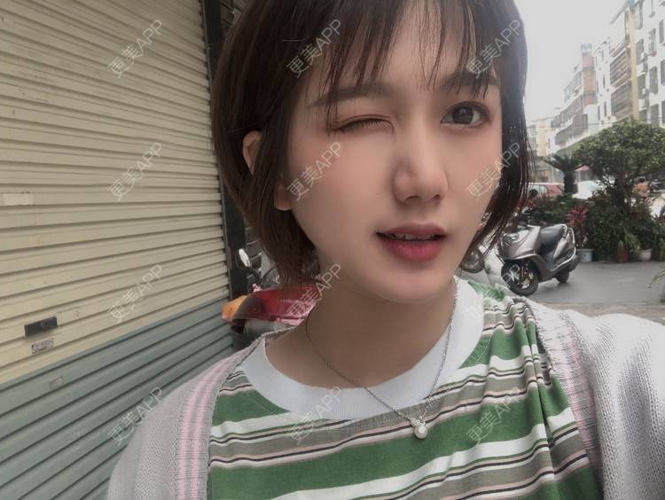 更美 - 阳海斌 医生的埋线提升经验 | 埋线提升 | 视频日记 | 佛山