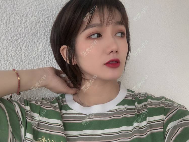 更美 - 阳海斌 医生的埋线提升经验 | 埋线提升 | 视频日记 | 佛山