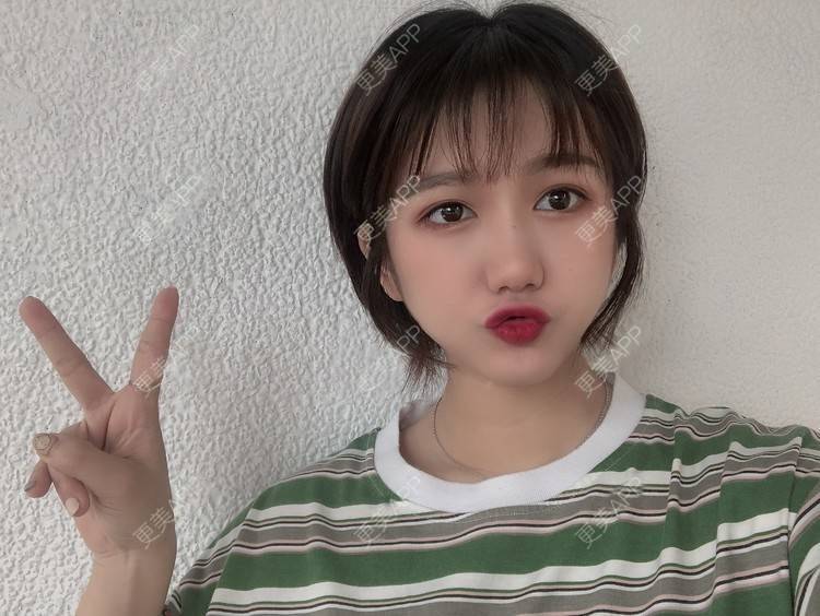 更美 - 阳海斌 医生的埋线提升经验 | 埋线提升 | 视频日记 | 佛山