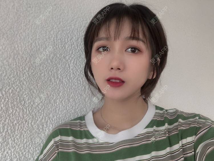 更美 - 阳海斌 医生的埋线提升经验 | 埋线提升 | 视频日记 | 佛山