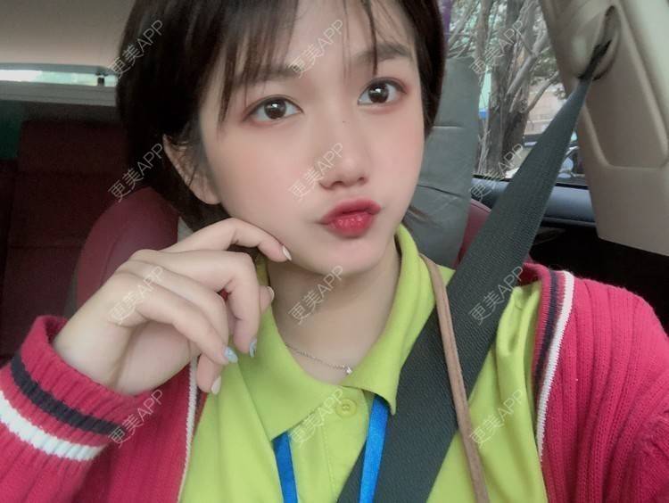 更美 - 阳海斌 医生的埋线提升经验 | 埋线提升 | 视频日记 | 佛山