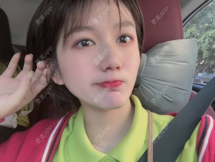 更美 - 阳海斌 医生的埋线提升经验 | 埋线提升 | 视频日记 | 佛山