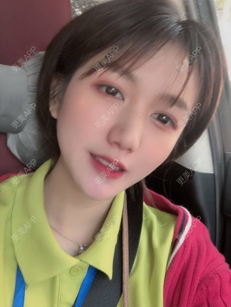 更美 - 阳海斌 医生的埋线提升经验 | 埋线提升 | 视频日记 | 佛山