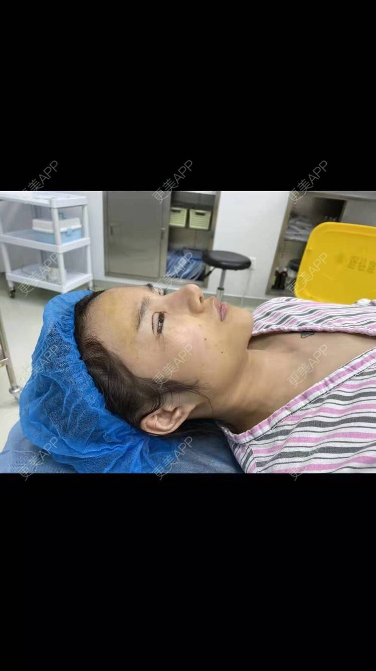 更美 - 变美找我~的肋软骨隆鼻经验 | 肋软骨隆鼻 | 鼻翼缩小 | 宁波 | 鼻孔矫正 | 眼部多项 | 自体肋软骨垫鼻基底