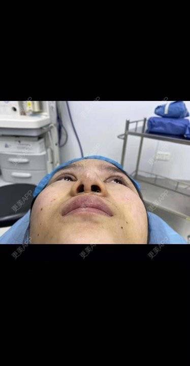 更美 - 变美找我~的肋软骨隆鼻经验 | 肋软骨隆鼻 | 鼻翼缩小 | 宁波 | 鼻孔矫正 | 眼部多项 | 自体肋软骨垫鼻基底