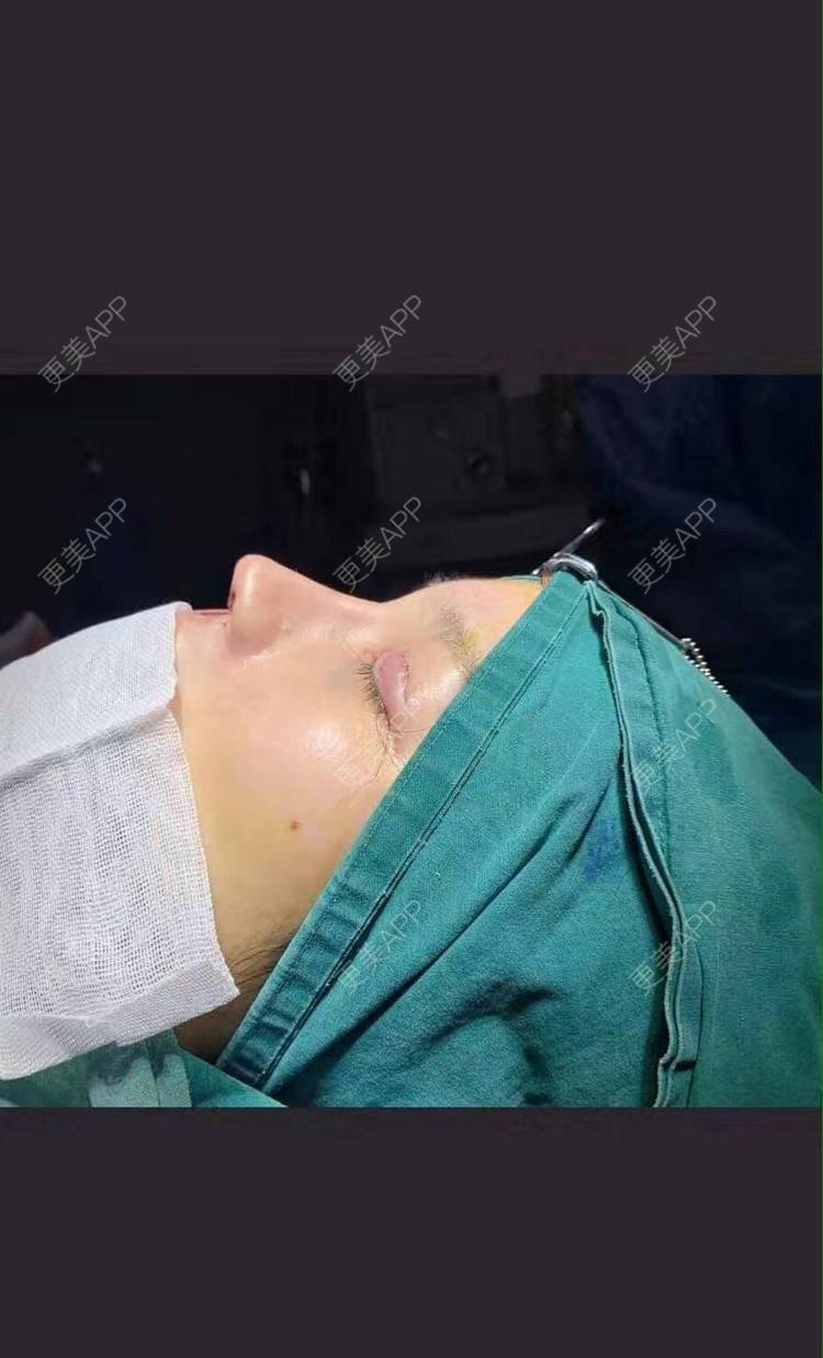 更美 - 变美找我~的肋软骨隆鼻经验 | 肋软骨隆鼻 | 鼻翼缩小 | 宁波 | 鼻孔矫正 | 眼部多项 | 自体肋软骨垫鼻基底