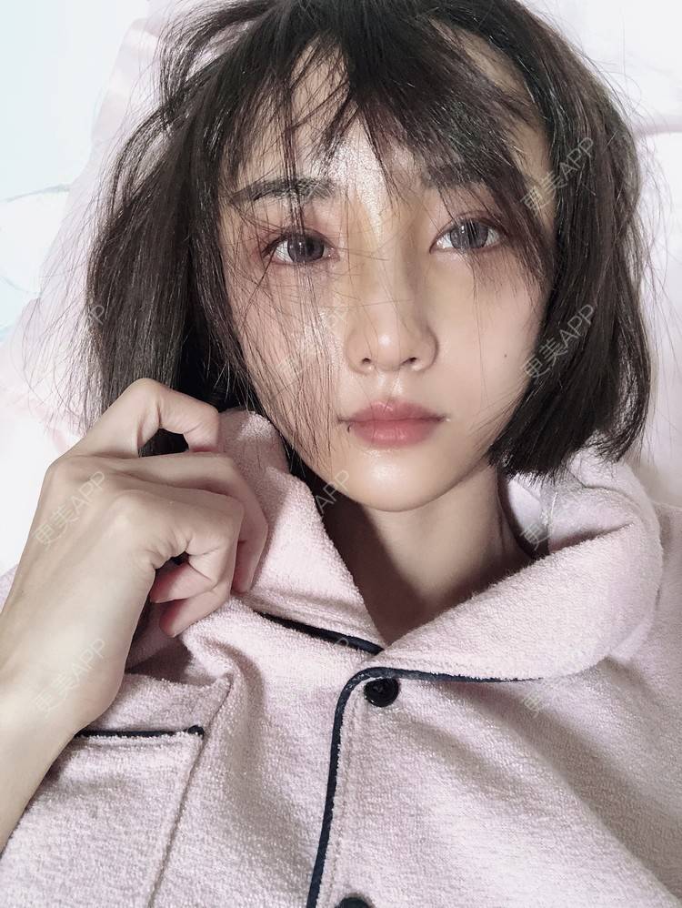 更美 - 更美用户ZYq2ZmuobY的自体脂肪丰苹果肌经验 | 自体脂肪丰苹果肌 | 自体脂肪丰面颊 | 自体脂肪丰太阳穴 | 自体脂肪垫下巴 | 自体脂肪丰额头 | 武汉