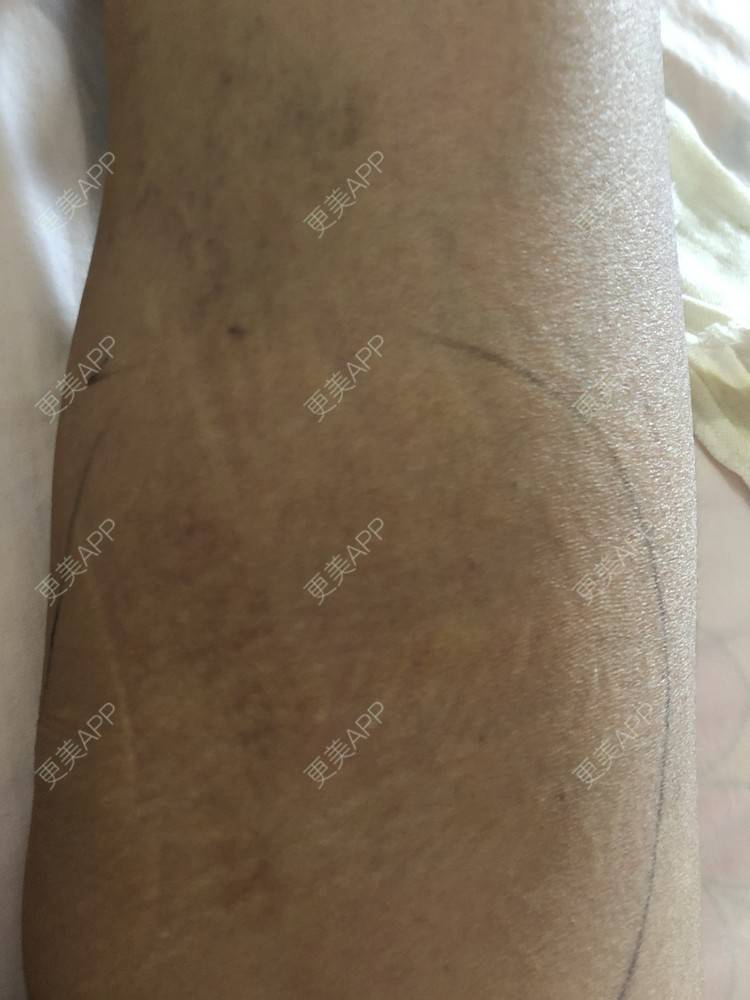 更美 - 更美用户ZYq2ZmuobY的自体脂肪丰苹果肌经验 | 自体脂肪丰苹果肌 | 自体脂肪丰面颊 | 自体脂肪丰太阳穴 | 自体脂肪垫下巴 | 自体脂肪丰额头 | 武汉