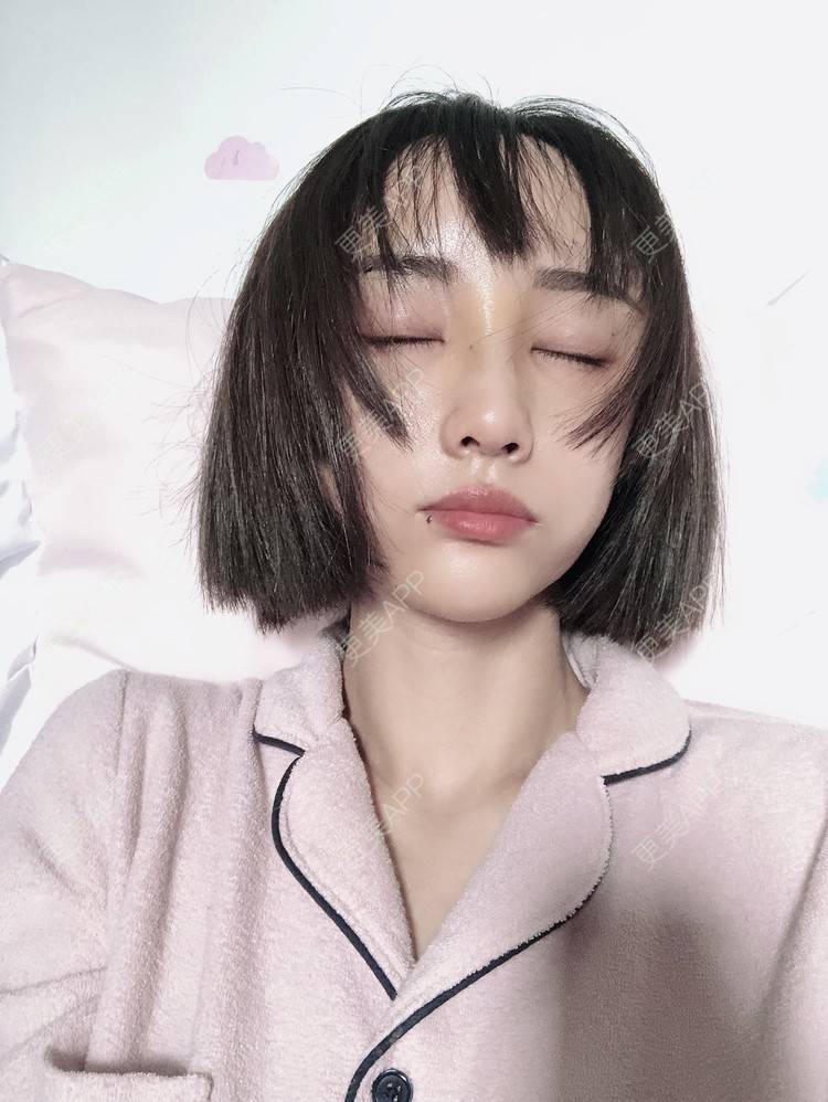 更美 - 更美用户ZYq2ZmuobY的自体脂肪丰苹果肌经验 | 耳软骨隆鼻 | 自体脂肪丰太阳穴 | 自体脂肪垫下巴 | 自体脂肪丰面颊 | 自体脂肪全面部填充 | 自体脂肪丰苹果肌 | 自体脂肪丰额头 | 武汉
