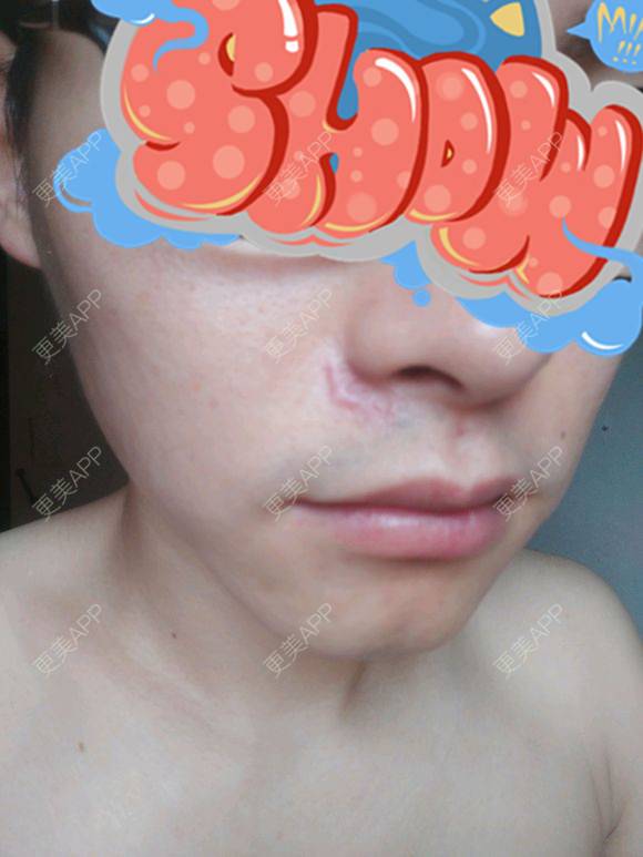 更美 - 高元宗 医生的激光淡疤经验 | 深圳 | 注射淡疤 | 激光淡疤