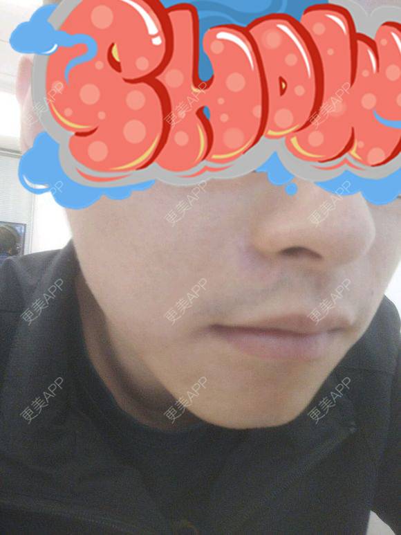 更美 - 高元宗 医生的激光淡疤经验 | 激光淡疤 | 注射淡疤 | 深圳