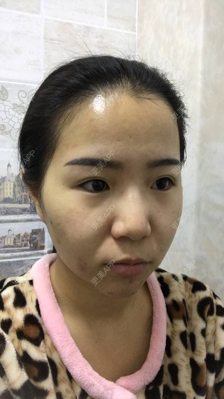 更美 - 烟雨朦朦中的埋线除皱经验 | 埋线除皱 | 成都