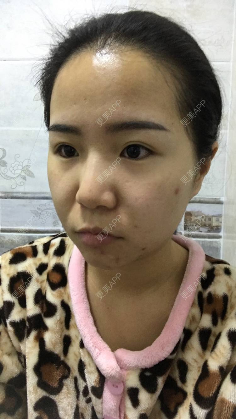 更美 - 烟雨朦朦中的埋线除皱经验 | 埋线除皱 | 成都