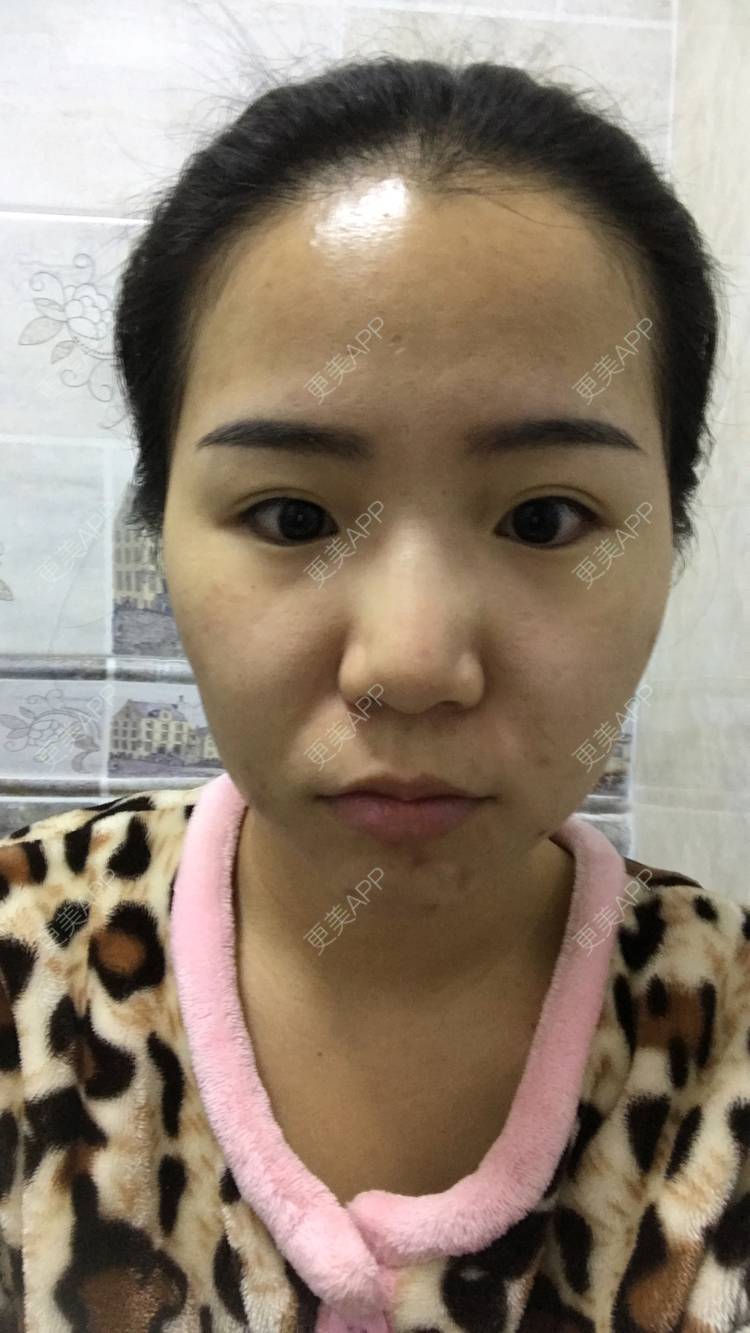 更美 - 烟雨朦朦中的埋线除皱经验 | 埋线除皱 | 成都