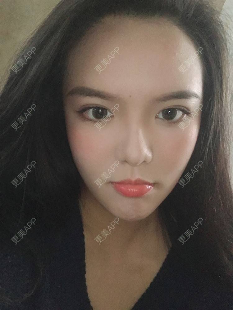 更美 - 更美用户X4LuQyEyHb的眼部多项经验 | 北京 | 眼部多项 | 视频日记