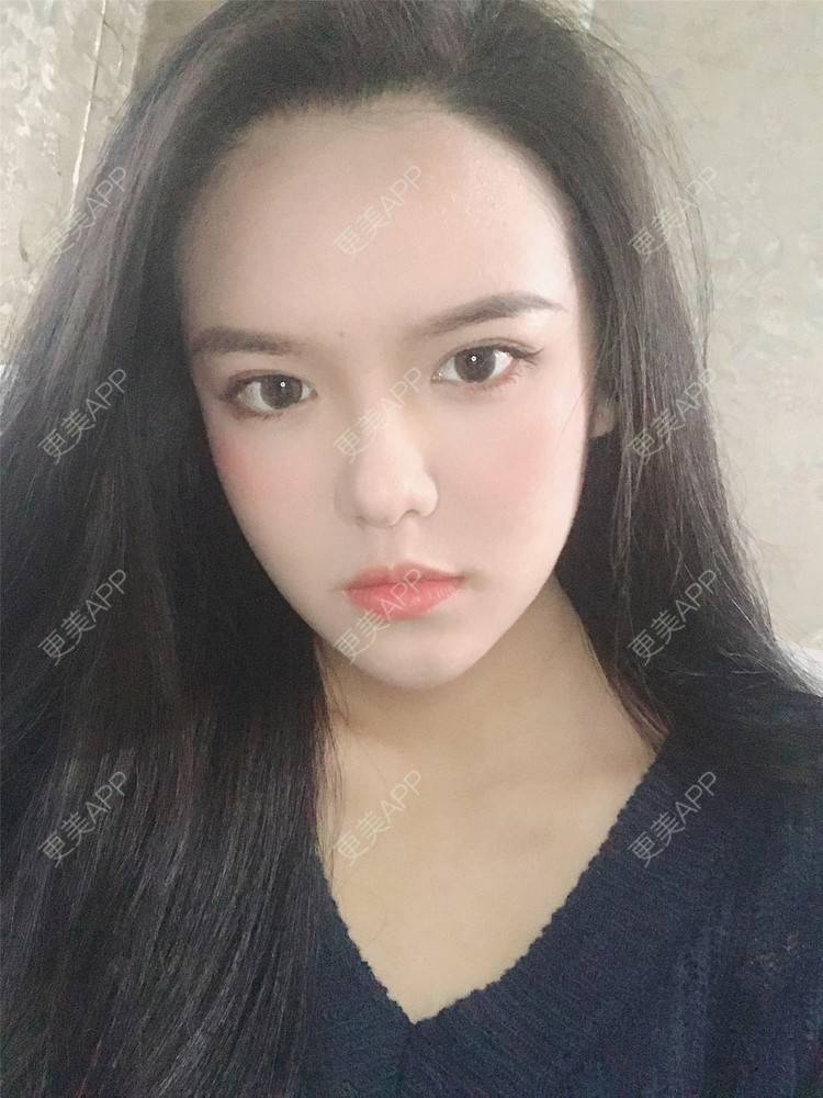 更美 - 更美用户X4LuQyEyHb的眼部多项经验 | 北京 | 眼部多项 | 视频日记