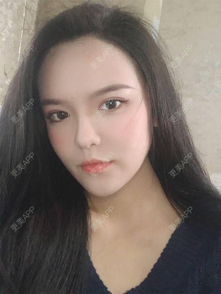 更美 - 更美用户X4LuQyEyHb的眼部多项经验 | 北京 | 眼部多项 | 视频日记