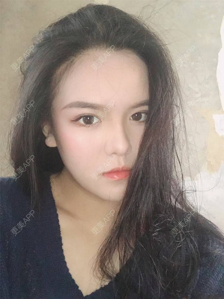 更美 - 更美用户X4LuQyEyHb的眼部多项经验 | 北京 | 眼部多项 | 视频日记