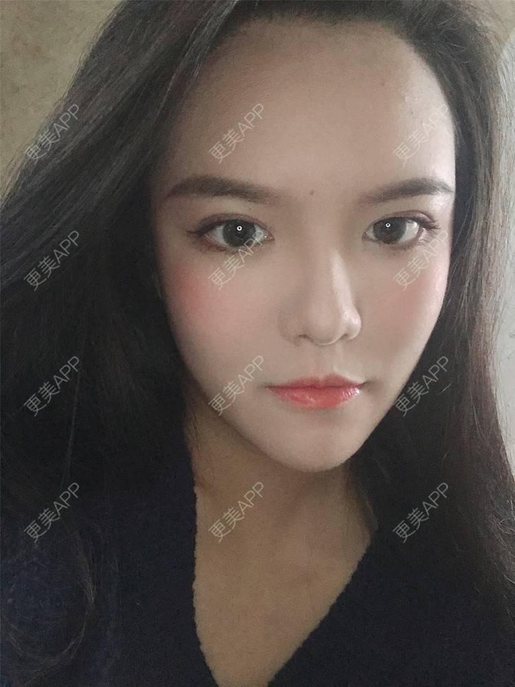 更美 - 更美用户X4LuQyEyHb的眼部多项经验 | 北京 | 眼部多项 | 视频日记