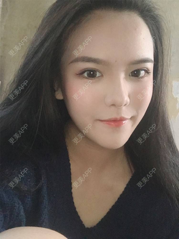 更美 - 更美用户X4LuQyEyHb的眼部多项经验 | 北京 | 眼部多项 | 视频日记