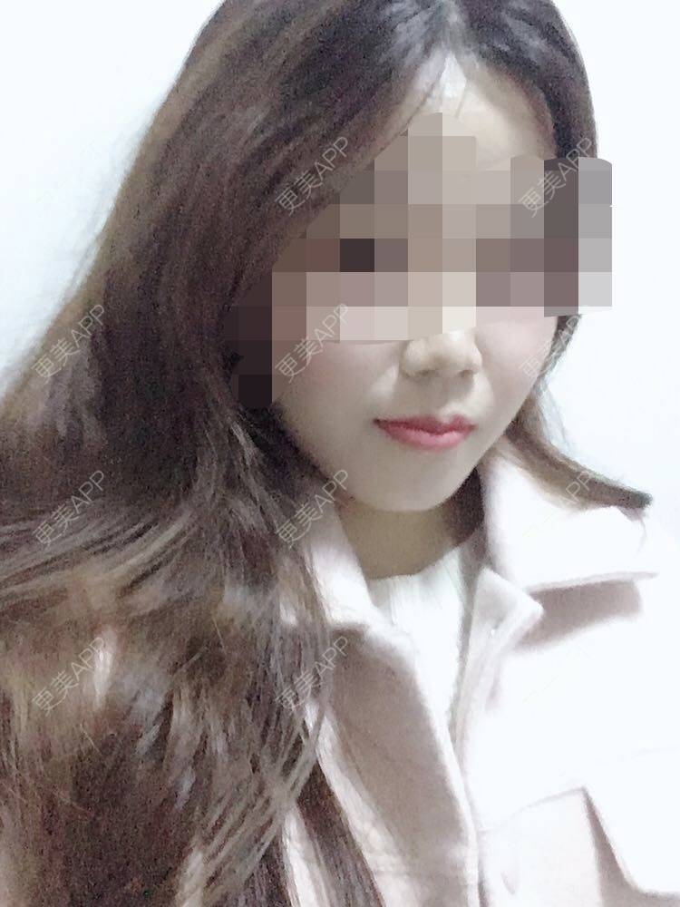 更美 - 更美用户oxU0xpBRZG的激光脱发际线经验 | 激光脱发际线 | 上海