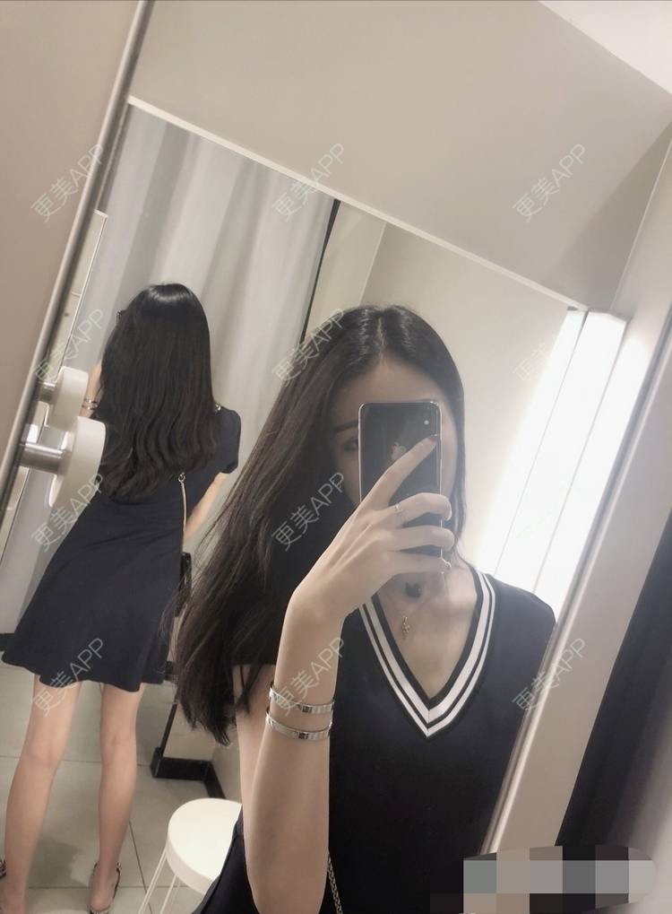更美 - 更美用户oxU0xpBRZG的激光脱发际线经验 | 激光脱发际线 | 上海