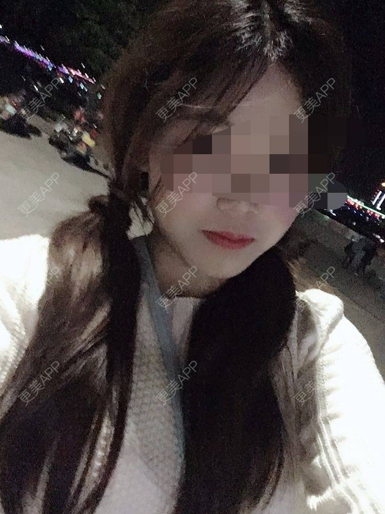 更美 - 更美用户oxU0xpBRZG的激光脱发际线经验 | 激光脱发际线 | 上海