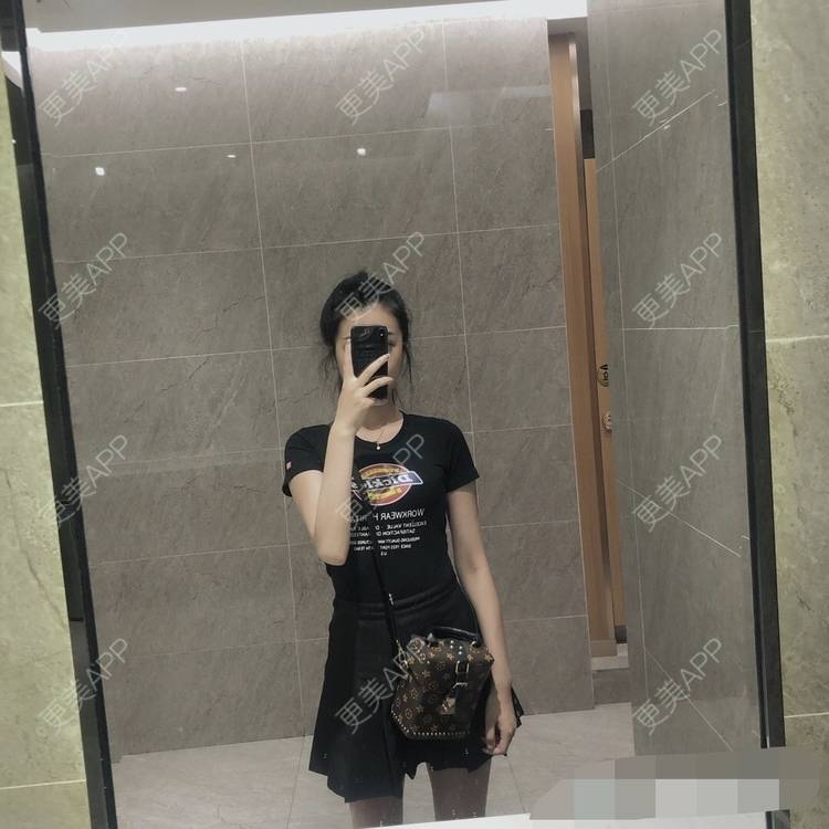 更美 - 更美用户oxU0xpBRZG的激光脱发际线经验 | 激光脱发际线 | 上海
