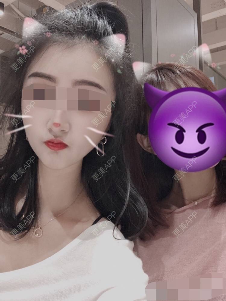 更美 - 更美用户oxU0xpBRZG的激光脱发际线经验 | 激光脱发际线 | 上海