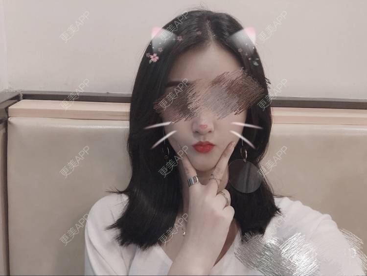 更美 - 更美用户oxU0xpBRZG的激光脱发际线经验 | 激光脱发际线 | 上海