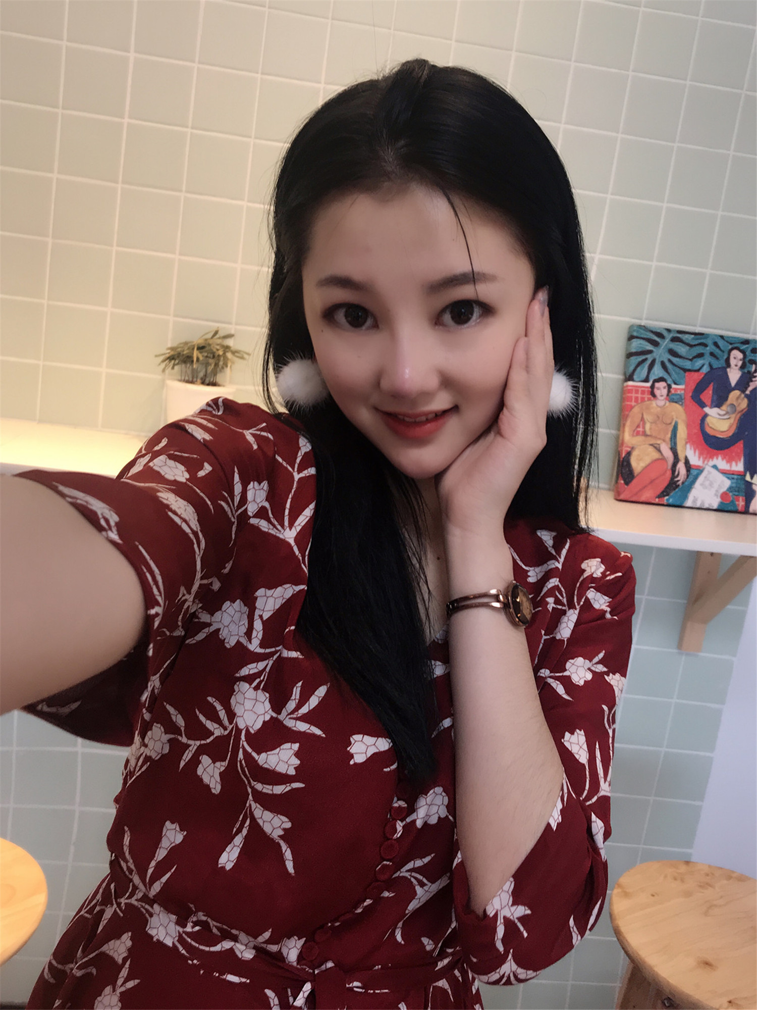 上海華東醫(yī)院整形科玻尿酸填充自然嗎？附豐蘋(píng)果肌恢復(fù)過(guò)程圖