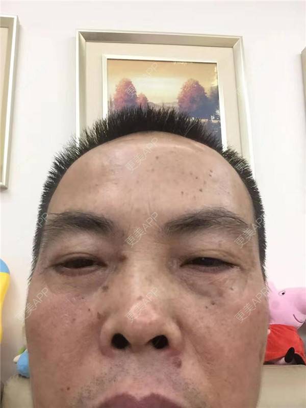 更美 - 更美用户IG0lQLfUjW的外切去眼袋经验 | 杭州 | 外切去眼袋