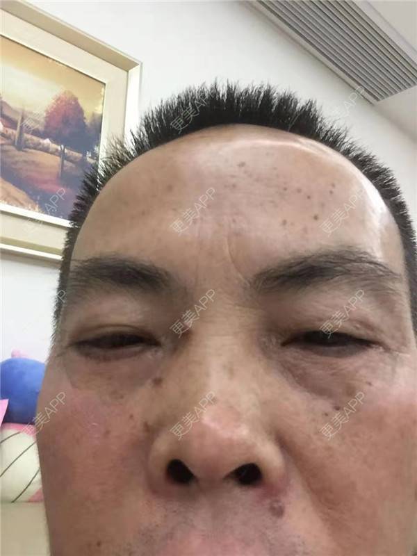 更美 - 更美用户IG0lQLfUjW的外切去眼袋经验 | 杭州 | 外切去眼袋