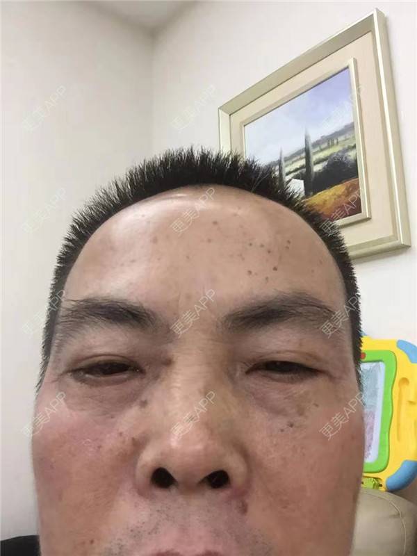 更美 - 更美用户IG0lQLfUjW的外切去眼袋经验 | 杭州 | 外切去眼袋