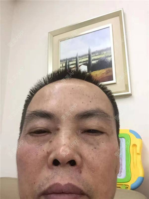 更美 - 更美用户IG0lQLfUjW的外切去眼袋经验 | 杭州 | 外切去眼袋