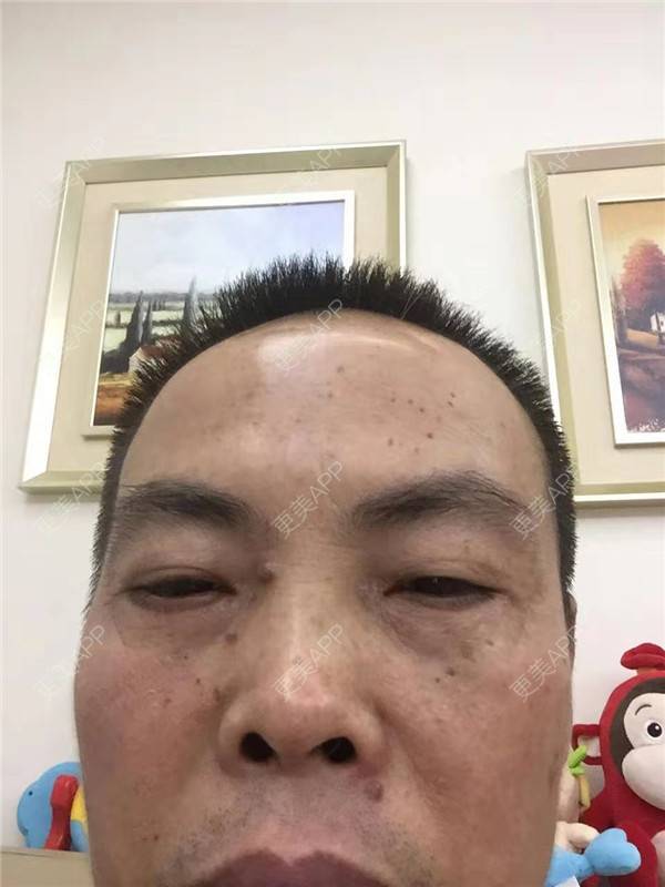 更美 - 更美用户IG0lQLfUjW的外切去眼袋经验 | 杭州 | 外切去眼袋