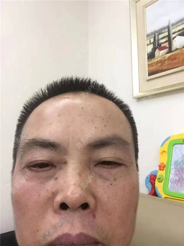 更美 - 更美用户IG0lQLfUjW的外切去眼袋经验 | 杭州 | 外切去眼袋