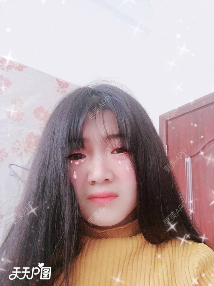 更美 - 更美用户4iauBWvNyf的玻尿酸苹果肌经验 | 玻尿酸苹果肌 | 玻尿酸太阳穴 | 玻尿酸唇部 | 玻尿酸面部细纹 | 玻尿酸耳垂 | 保定