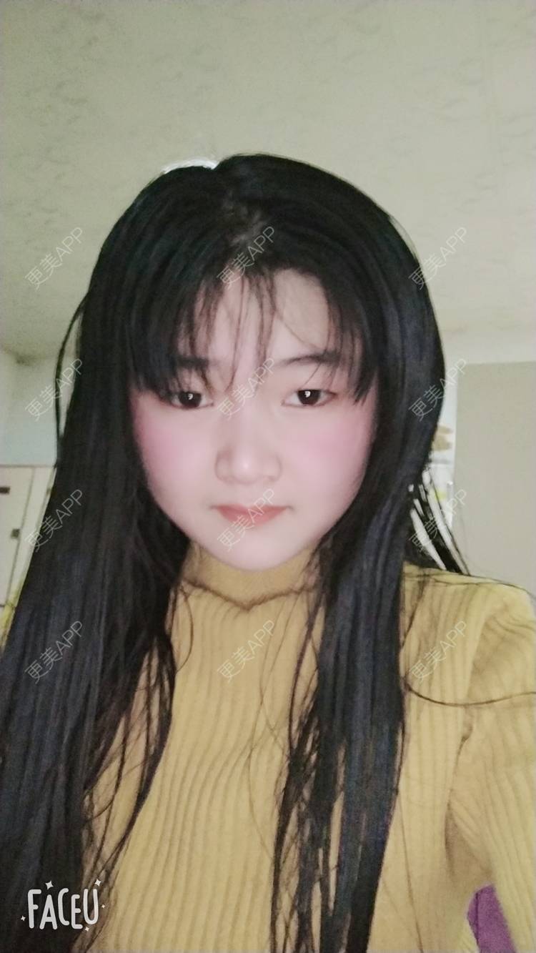 更美 - 更美用户4iauBWvNyf的玻尿酸苹果肌经验 | 玻尿酸苹果肌 | 玻尿酸太阳穴 | 玻尿酸唇部 | 玻尿酸面部细纹 | 玻尿酸耳垂 | 保定