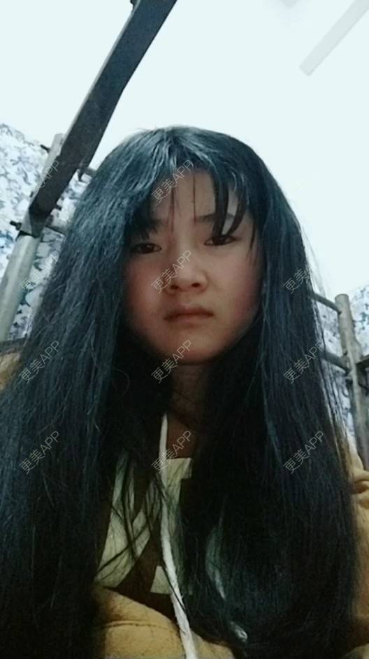 更美 - 更美用户4iauBWvNyf的玻尿酸苹果肌经验 | 玻尿酸苹果肌 | 玻尿酸太阳穴 | 玻尿酸唇部 | 玻尿酸面部细纹 | 玻尿酸耳垂 | 保定