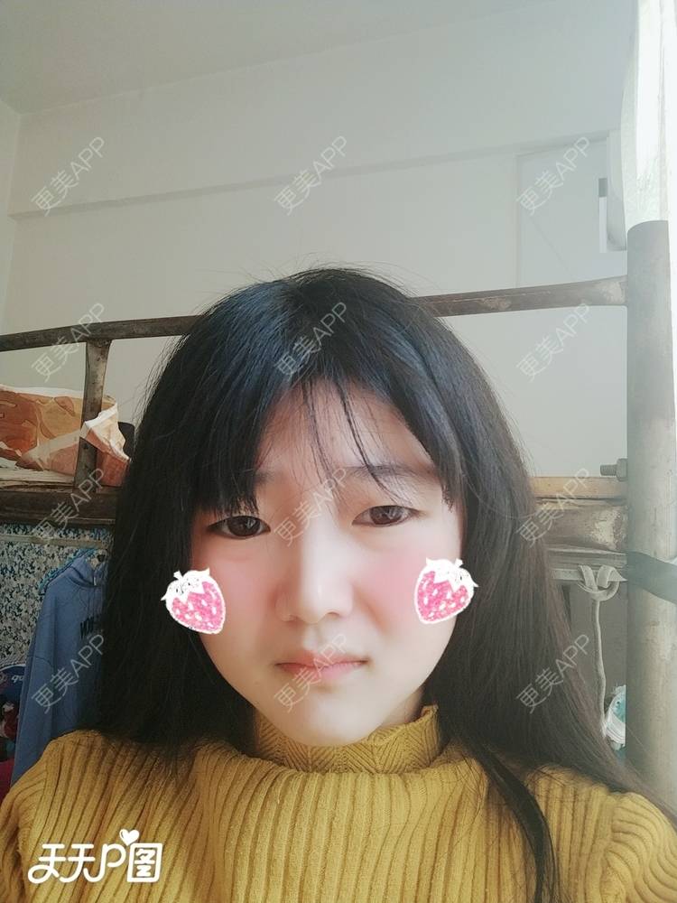 更美 - 更美用户4iauBWvNyf的玻尿酸苹果肌经验 | 玻尿酸苹果肌 | 玻尿酸太阳穴 | 玻尿酸唇部 | 玻尿酸面部细纹 | 玻尿酸耳垂 | 保定