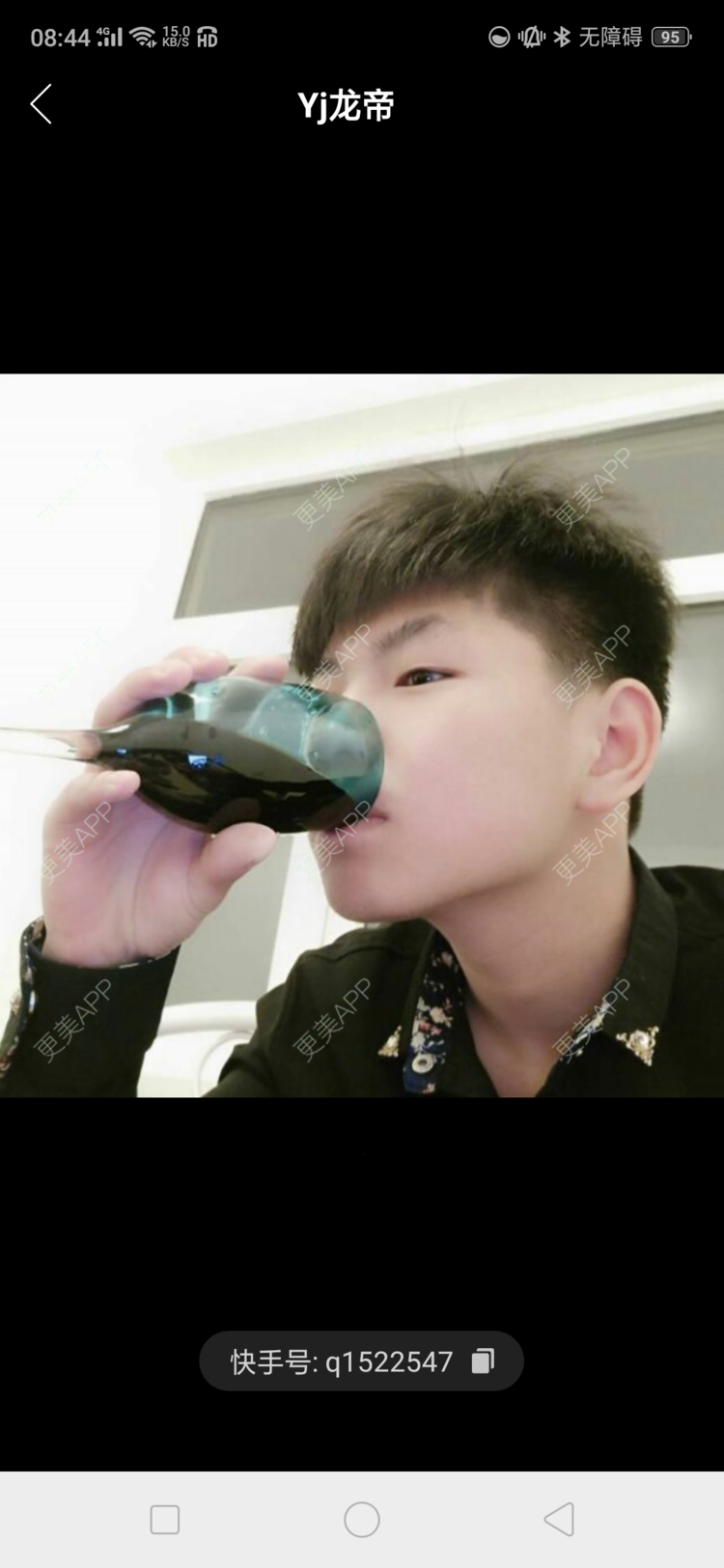 更美 - 更美用户4iauBWvNyf的玻尿酸苹果肌经验 | 视频日记 | 玻尿酸苹果肌 | 玻尿酸太阳穴 | 玻尿酸唇部 | 玻尿酸面部细纹 | 玻尿酸耳垂 | 保定