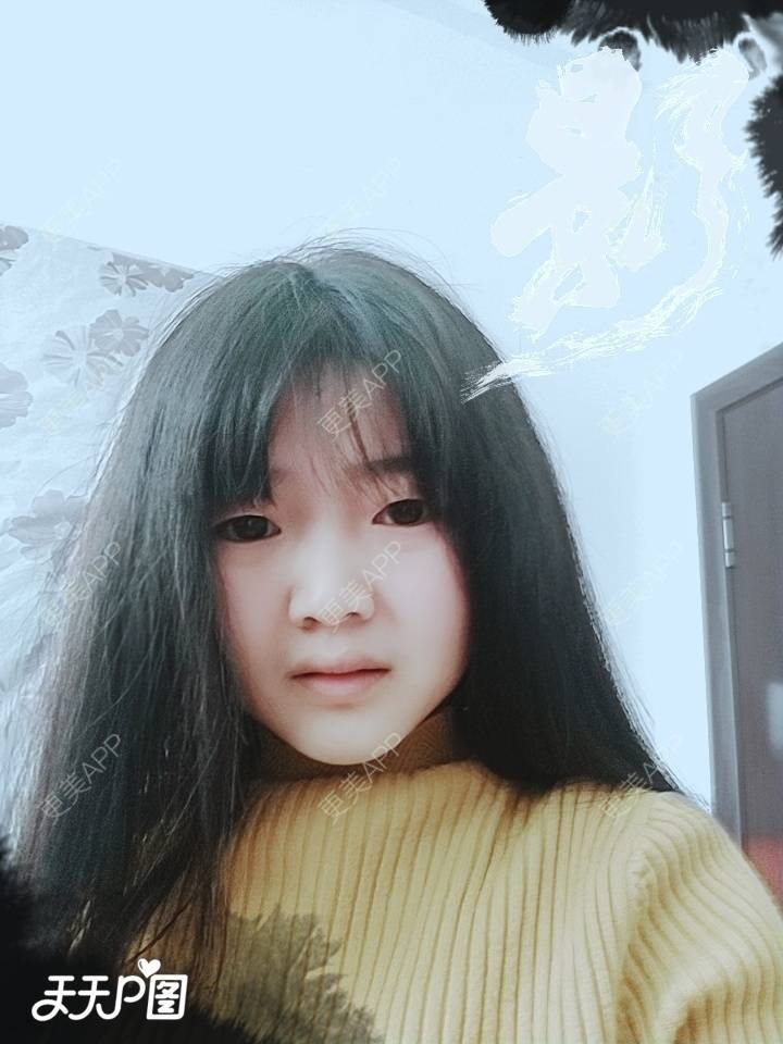 更美 - 更美用户4iauBWvNyf的玻尿酸苹果肌经验 | 玻尿酸苹果肌 | 玻尿酸太阳穴 | 玻尿酸唇部 | 玻尿酸面部细纹 | 玻尿酸耳垂 | 保定