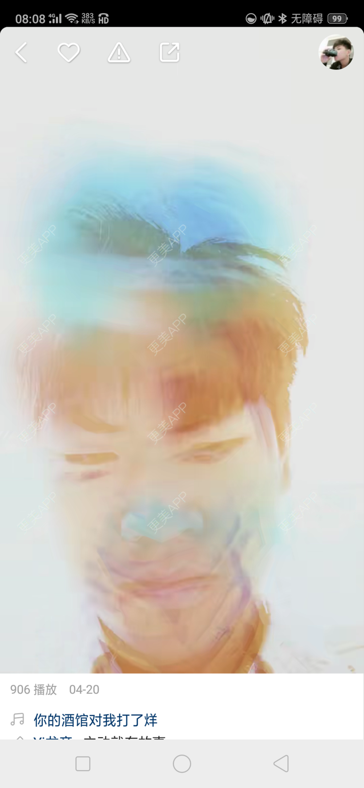 更美 - 更美用户4iauBWvNyf的玻尿酸苹果肌经验 | 视频日记 | 玻尿酸苹果肌 | 玻尿酸太阳穴 | 玻尿酸唇部 | 玻尿酸面部细纹 | 玻尿酸耳垂 | 保定